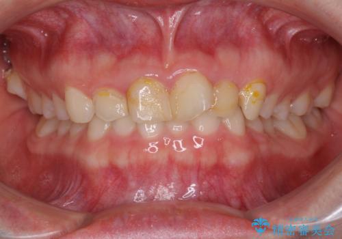 気になる前歯を美しく　マウスピース矯正とセラミッククラウンの症例 治療前