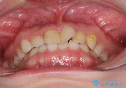 気になる前歯を美しく マウスピース矯正とセラミッククラウンの治療前