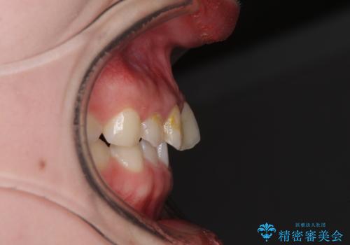 気になる前歯を美しく マウスピース矯正とセラミッククラウンの治療前