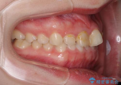気になる前歯を美しく マウスピース矯正とセラミッククラウンの治療前