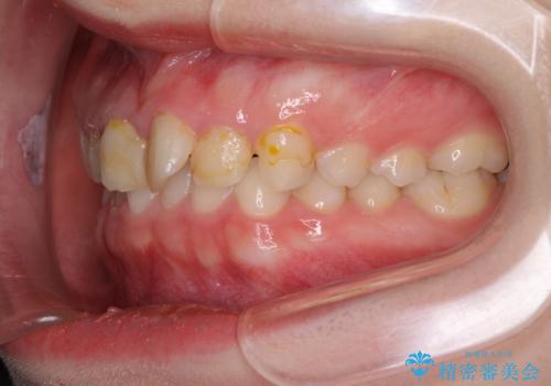 気になる前歯を美しく マウスピース矯正とセラミッククラウンの治療前