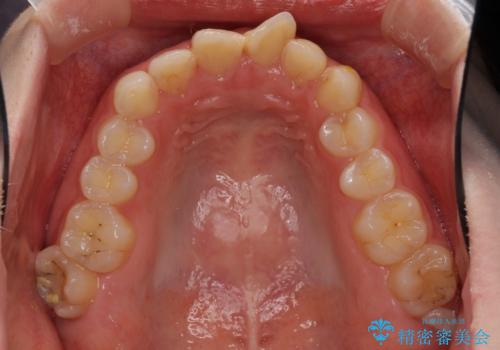 気になる前歯を美しく マウスピース矯正とセラミッククラウンの治療前