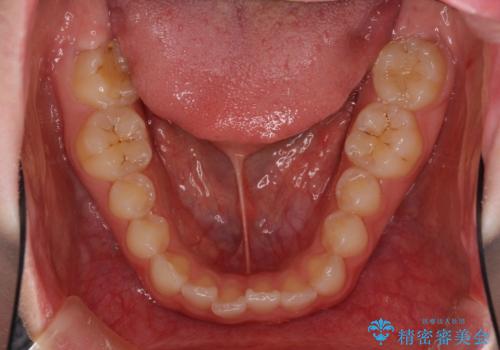 気になる前歯を美しく マウスピース矯正とセラミッククラウンの治療前