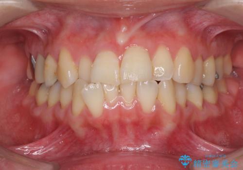 切端咬合をインビザライン矯正で解消の治療前
