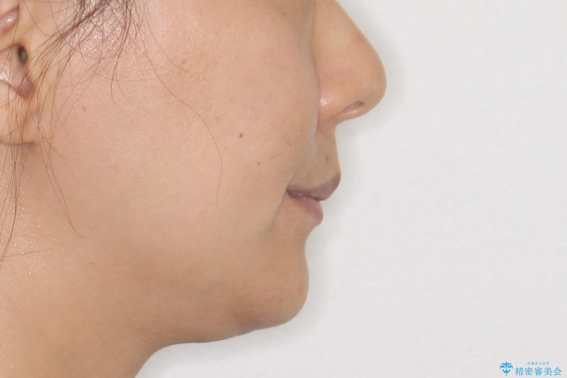 口元が出てるのが気になる 抜歯矯正でしっかりと前歯をさげてすっきりした口元への治療後(顔貌)