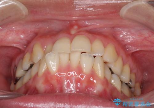 切端咬合をインビザライン矯正で解消の治療前