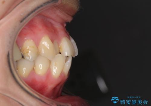 切端咬合をインビザライン矯正で解消の治療前