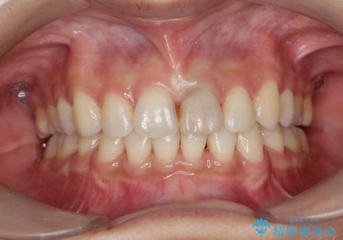 口元が出てるのが気になる 抜歯矯正でしっかりと前歯をさげてすっきりした口元への治療後