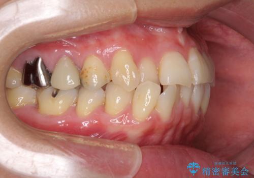 切端咬合をインビザライン矯正で解消の治療前