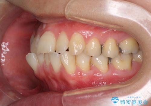 切端咬合をインビザライン矯正で解消の治療前