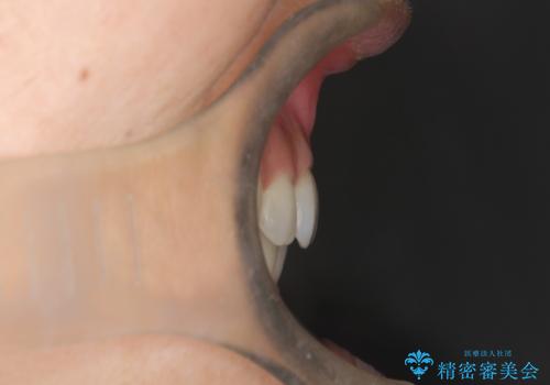 口元が出てるのが気になる 抜歯矯正でしっかりと前歯をさげてすっきりした口元への治療後