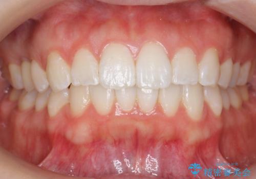 前歯のがたつき インビザラインでの症例 治療後