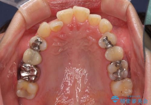 切端咬合をインビザライン矯正で解消の治療前