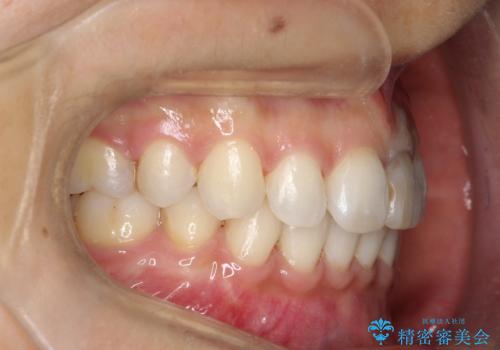 口元が出てるのが気になる 抜歯矯正でしっかりと前歯をさげてすっきりした口元への治療後
