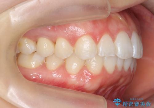 前歯のがたつき インビザラインでの治療後