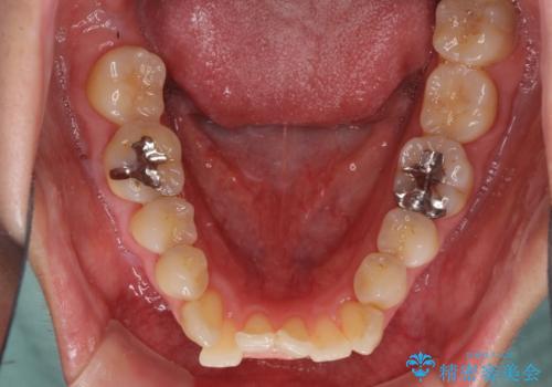 切端咬合をインビザライン矯正で解消の治療前
