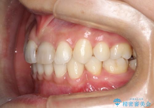 口元が出てるのが気になる 抜歯矯正でしっかりと前歯をさげてすっきりした口元への治療後