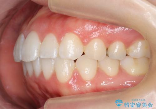 前歯のがたつき インビザラインでの治療後