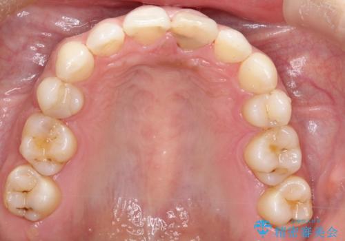 口元が出てるのが気になる 抜歯矯正でしっかりと前歯をさげてすっきりした口元への治療後