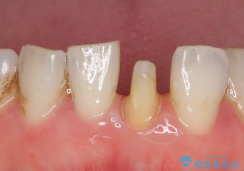 オールセラミッククラウン 変色した前歯をセラミックで白くの治療中