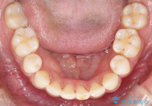 口元が出てるのが気になる 抜歯矯正でしっかりと前歯をさげてすっきりした口元への治療後