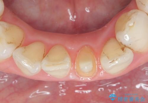 オールセラミッククラウン 変色した前歯をセラミックで白くの治療中