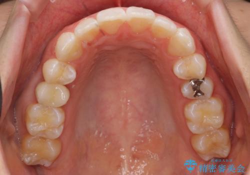 前歯のがたつき インビザラインでの治療後