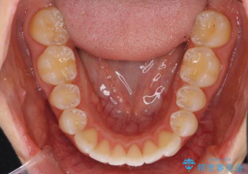 前歯のがたつき インビザラインでの治療後