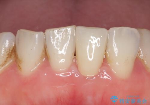 オールセラミッククラウン 変色した前歯をセラミックで白くの症例 治療後