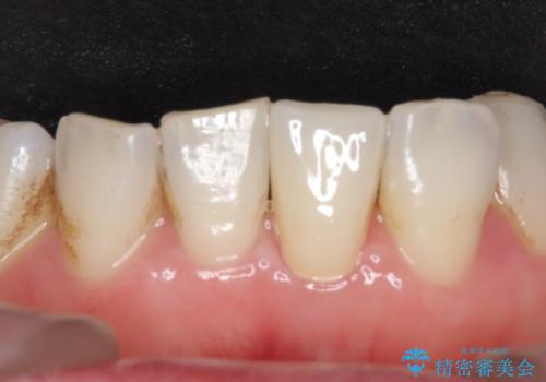 オールセラミッククラウン 変色した前歯をセラミックで白くの治療後