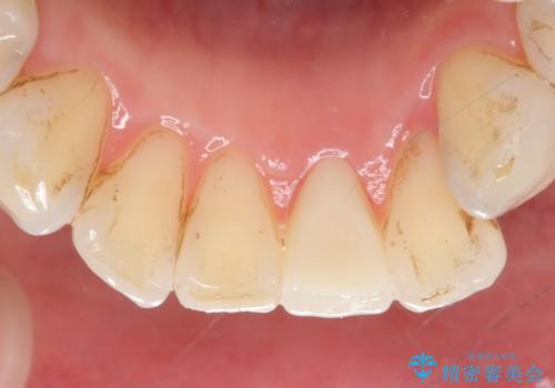 オールセラミッククラウン 変色した前歯をセラミックで白くの治療後