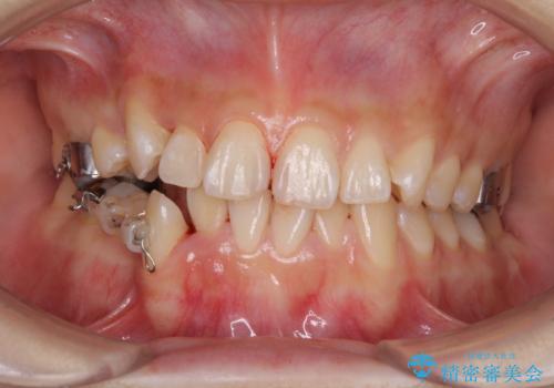上下の八重歯を治したい　補助装置を用いたインビザライン矯正の治療中