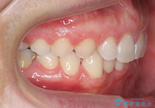 すきっ歯・出っ歯　コンプレックスの前歯を治したい　目立たない方法で　セラミック治療は不可能な症例の治療後
