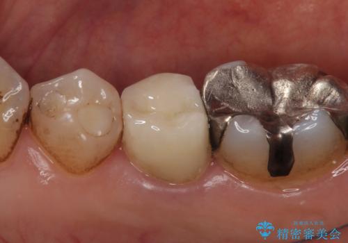 オールセラミッククラウン 違和感のある奥歯の治療の治療後
