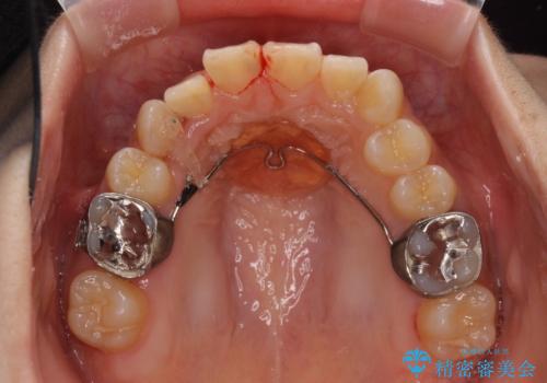 上下の八重歯を治したい　補助装置を用いたインビザライン矯正の治療中