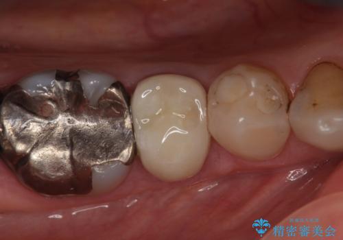 オールセラミッククラウン 違和感のある奥歯の治療の治療後