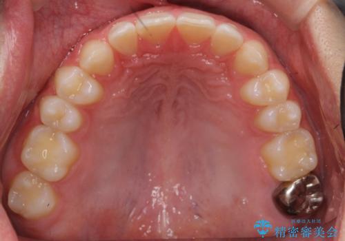 すきっ歯・出っ歯　コンプレックスの前歯を治したい　目立たない方法で　セラミック治療は不可能な症例の治療後