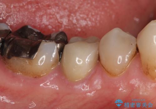 オールセラミッククラウン 違和感のある奥歯の治療の治療後