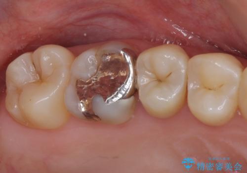 虫歯がしみる　セラミックインレーによる修復治療の治療前