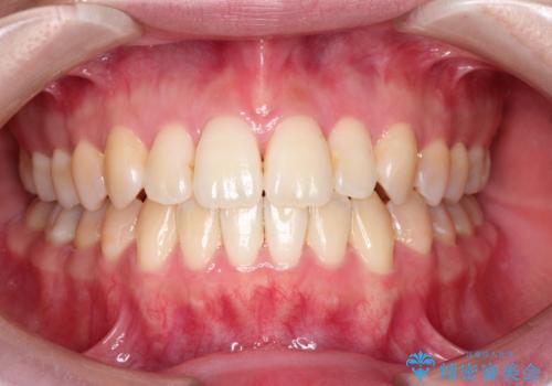 仕事上装置をつけることができない インビザラインで目立たない矯正の症例 治療後