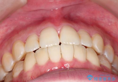 仕事上装置をつけることができない インビザラインで目立たない矯正の治療後