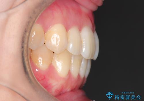 仕事上装置をつけることができない インビザラインで目立たない矯正の治療後