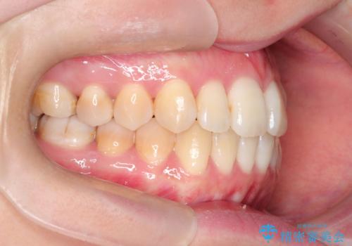 仕事上装置をつけることができない インビザラインで目立たない矯正の治療後