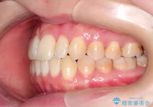 仕事上装置をつけることができない インビザラインで目立たない矯正の治療後