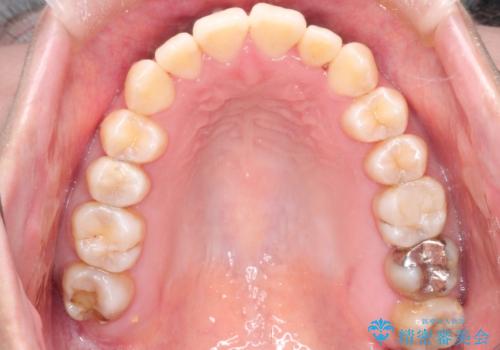 仕事上装置をつけることができない インビザラインで目立たない矯正の治療後