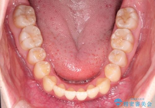 仕事上装置をつけることができない インビザラインで目立たない矯正の治療後