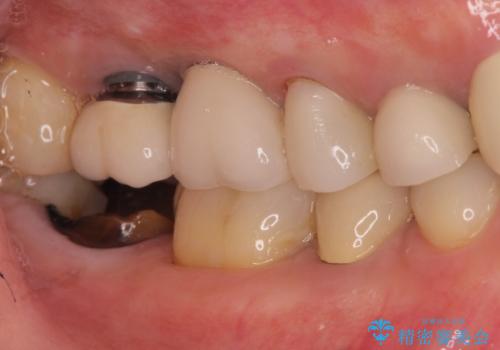 右下の奥歯を抜歯　インプラント治療による咬合回復の治療前
