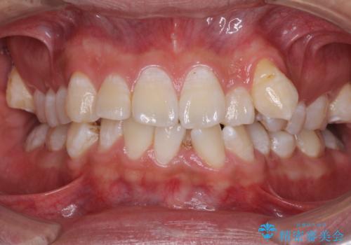 前歯の叢生を解消　ワイヤー装置での抜歯矯正の症例 治療前