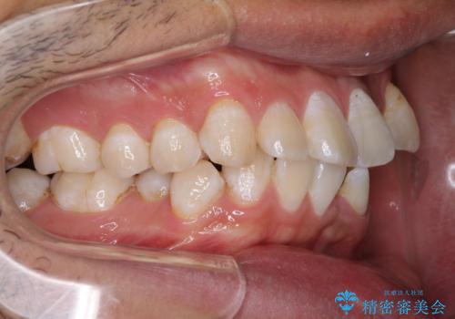 前歯の叢生を解消　ワイヤー装置での抜歯矯正の治療前