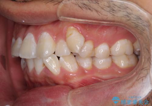 前歯の叢生を解消　ワイヤー装置での抜歯矯正の治療前